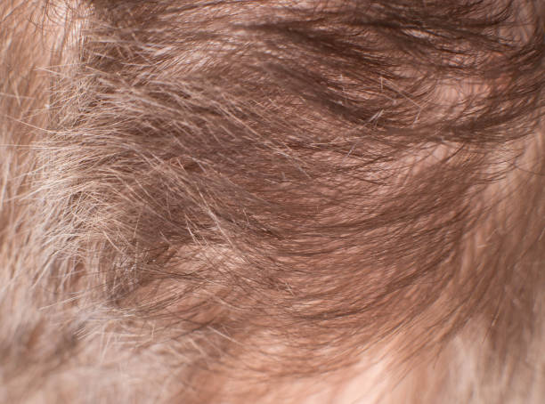 istock brown hair on a human head, closeup, background, dermatology 1206843278