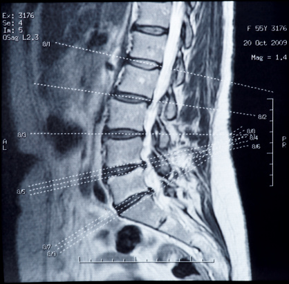 Real MRI scan of human spine, diskal hernias are seen, patient's data cloned out