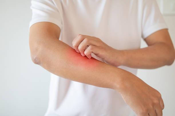istock man itching and scratching on arm from itchy dry skin eczema dermatitis 1206954849
