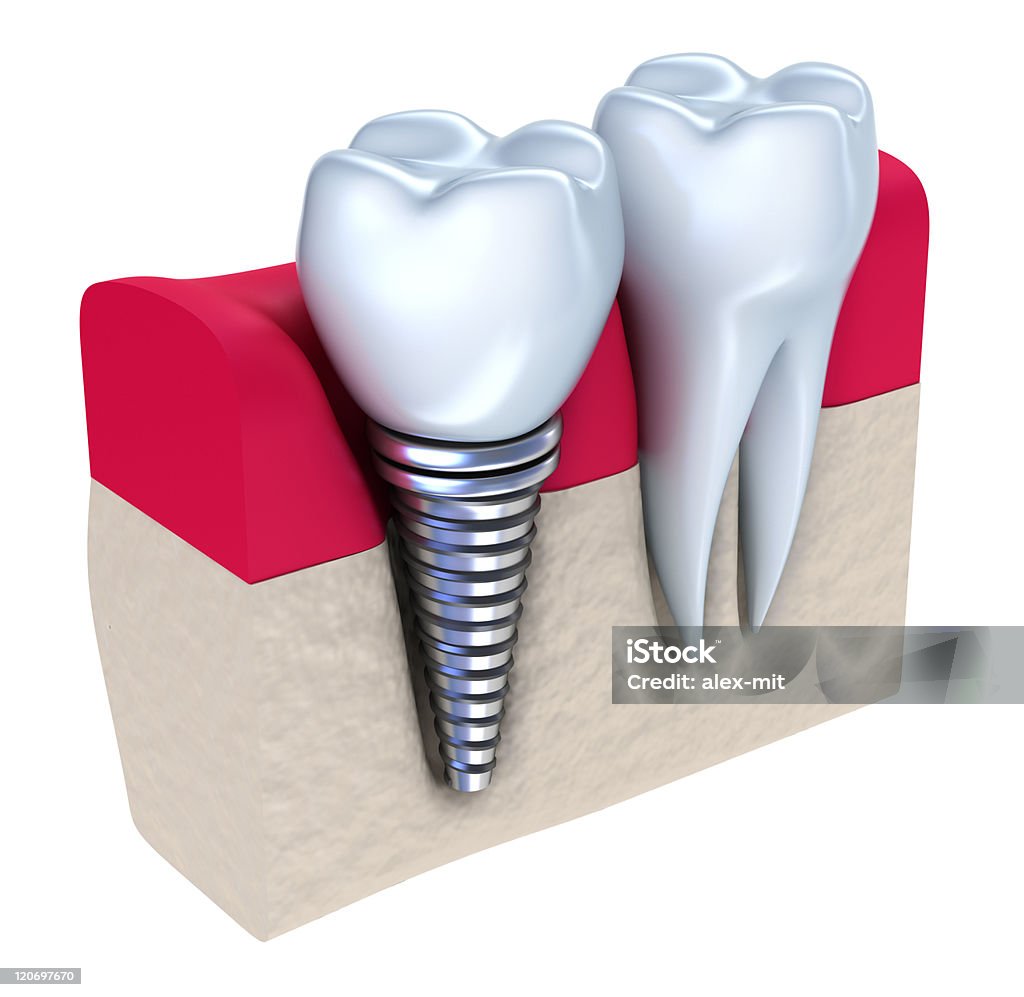 Зубной имплантат-implanted в Челюстная кость - Стоковые фото Белый роялти-фри