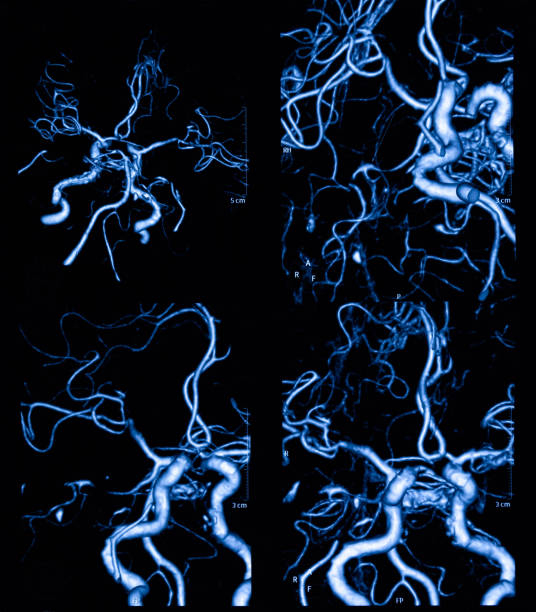 mri skanowania ludzkiej tętnicy mózgowej tomografia - brain physical injury x ray image x ray zdjęcia i obrazy z banku zdjęć
