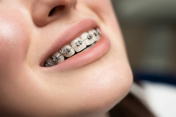 leczenie ortodontyczne. koncepcja opieki stomatologicznej. piękna kobieta zdrowy uśmiech z bliska. zbliżenie ceramiczne i metalowe wsporniki - dentist pain human teeth toothache zdjęcia i obrazy z banku zdjęć