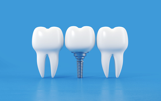 Tooth sitting next to dental implant on blue background, Horizontal composition with copy space.