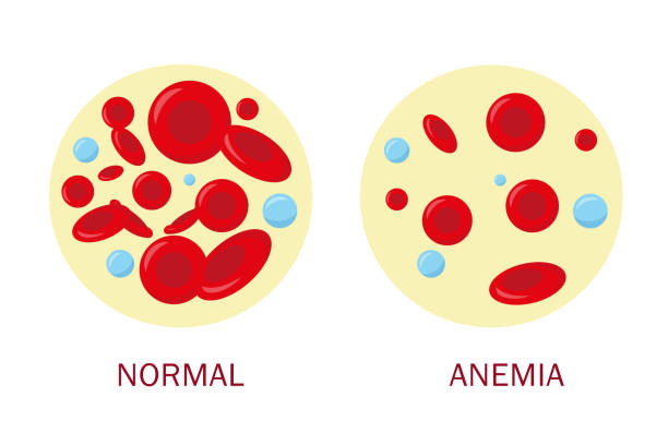 Nolmal blood cell and anemia blood cell. Medical concept. Vector illustration. Nolmal blood cell and anemia blood cell. Medical concept. Vector illustration. anemia stock illustrations