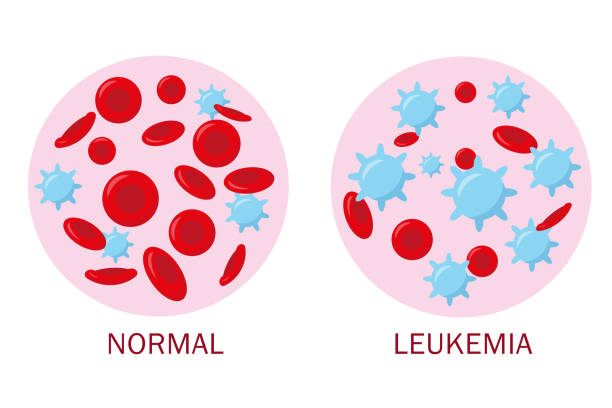 darah normal dan darah leukemia untuk konsep medis. analisis darah atau spanduk uji leukemia. ilustrasi vektor. - kanker darah ilustrasi stok