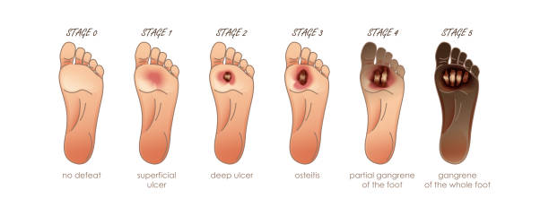ilustraciones, imágenes clip art, dibujos animados e iconos de stock de pie diabético. etapas de derrota. úlceras, llagas en la piel en el pie - diabetes
