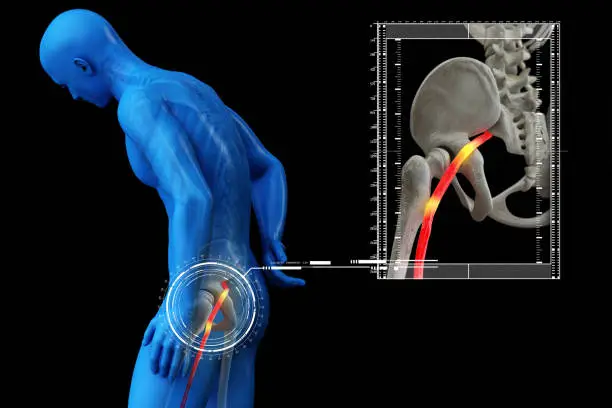 Photo of Pinched human sciatic nerve, anatomical vision. 3D Render.