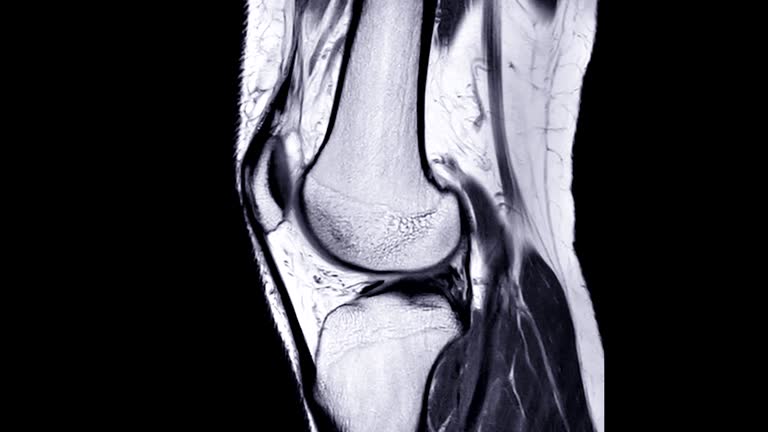 MRI knee or Magnetic resonance imaging of knee joint  sagittal PDW view.