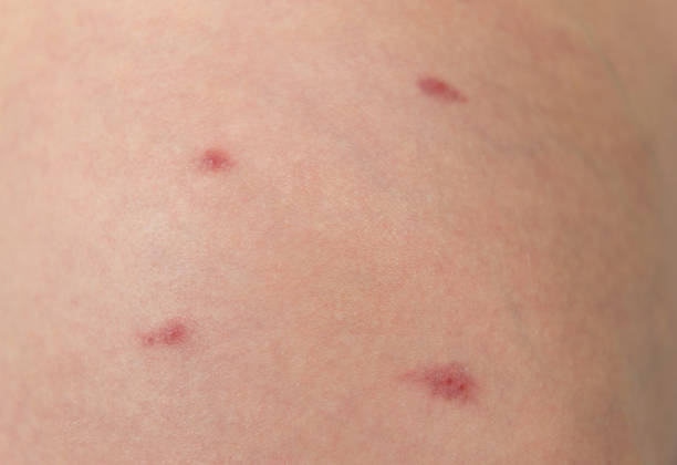 istock Allergy on naked skin 1207817180