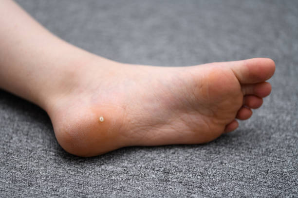 Plantar wart on childs foot causing pain. HPV Foot wart, verrucas plantar on the foot of a child from Sweden. A  decease caused by the Human papillomavirus (HPV) and often spread at communal showers or by sharing socks with others. wart stock pictures, royalty-free photos & images