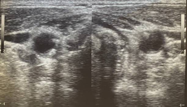 istock Atherosclerosis plaque in human carotid artery 1207898478