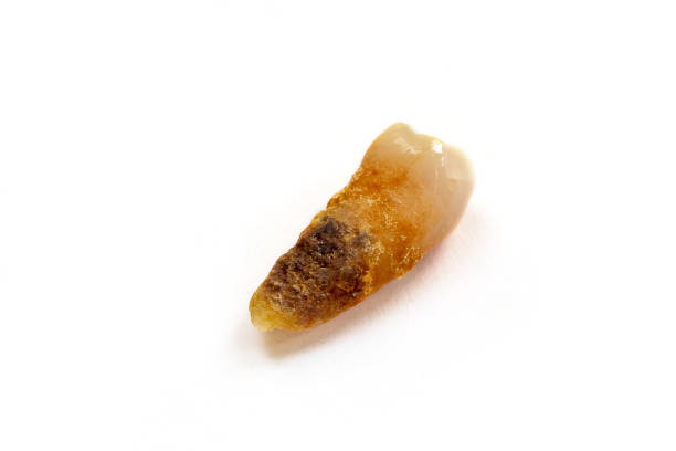 istock A close up tooth with severe tooth decay 1208126441