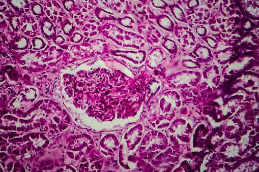 Histopathology of diffuse sclerosing glomerulonephritis, light micrograph, photo under microscope