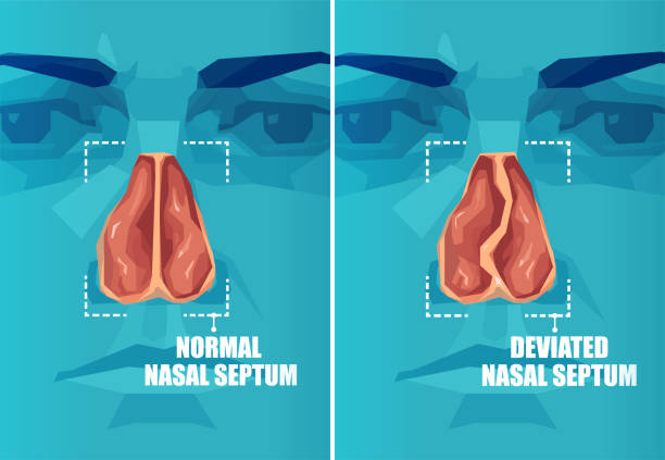 illustrazioni stock, clip art, cartoni animati e icone di tendenza di sezione trasversale vettoriale del viso umano con setto nasale deviato e normale - nose job illustrations