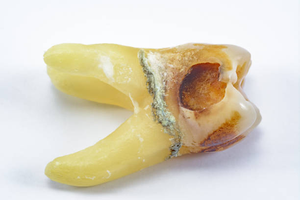 istock affected by caries, destroyed with a large cavity, removed human tooth with large roots, chewing molar tooth, wisdom tooth, tooth extraction operation, dental surgery 1208221220