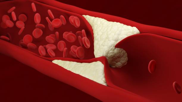 atherosklerose. rote blutkörperchen.  arterie. aufbau von plaque. verlust der elastizität der wände der arterien. verdickung und verhärtung. blutfluss. - cholesterin stock-fotos und bilder