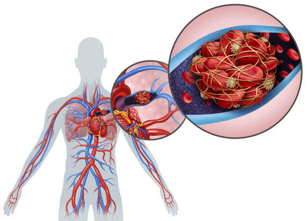 anatomie de l’embolie pulmonaire - thrombose photos et images de collection