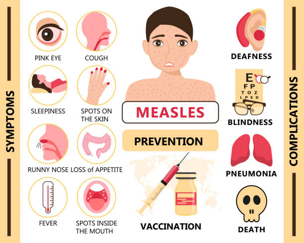 Measles infographic concept vector. Infected human with papules on the skin. Rubeola symptoms and complications illustration. Measles infographic concept vector. Infected human with papules on the skin. Rubeola symptoms and complications illustration. Agitation of vaccination and prevention of measles for medical website. measles illustrations stock illustrations