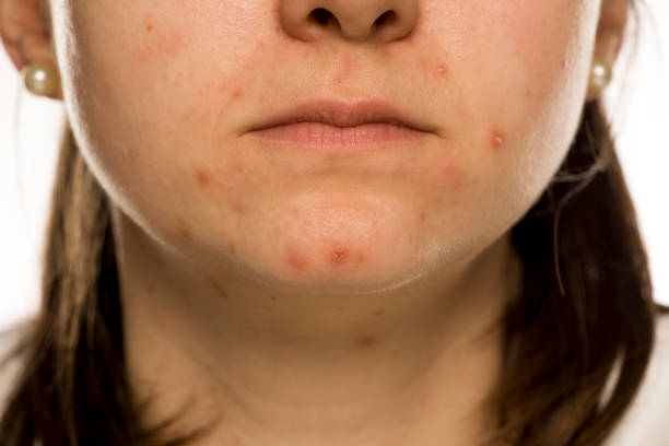 istock closeup of female face with problematic skin 1208532104