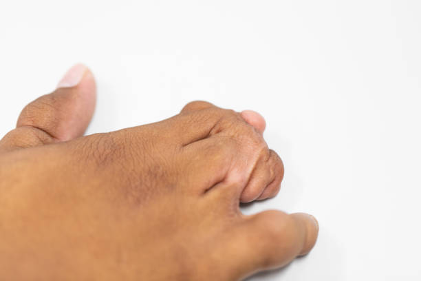 istock Abnormal fingers caused by genetic diseases for education in laboratories. 1208547654