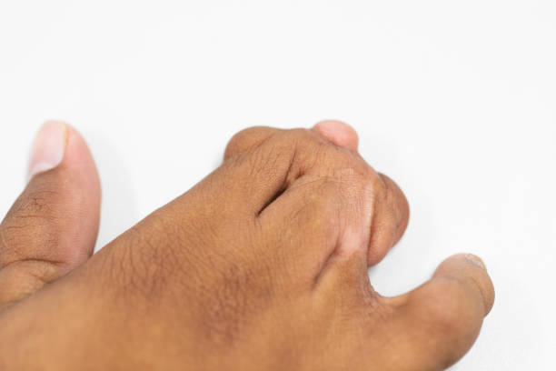 istock Abnormal fingers caused by genetic diseases for education in laboratories. 1208547658