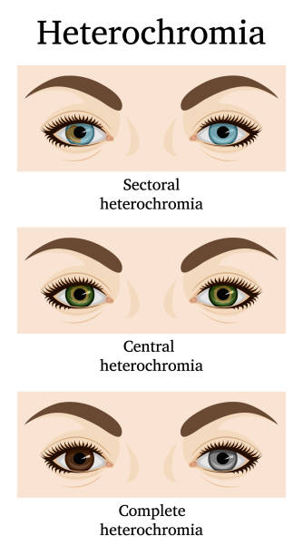 istock Illustration of Heterochromia iridum 1208585384