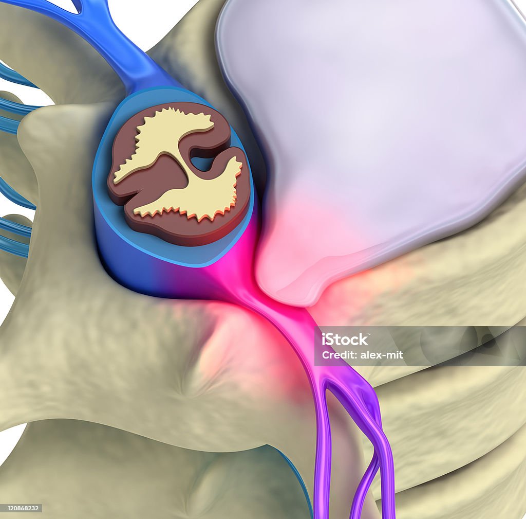 Prolapse intervertebral Gros plan de remise - Photo de Colonne vertébrale - Partie du corps libre de droits