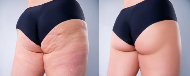 Overweight woman with fat legs and buttocks, before after weight loss concept on gray background Overweight woman with fat legs and buttocks, before after weight loss concept, obesity female body on gray background cellulite stock pictures, royalty-free photos & images