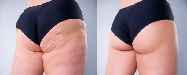 overweight woman with fat legs and buttocks, before after weight loss concept on gray background - women human leg body buttocks imagens e fotografias de stock