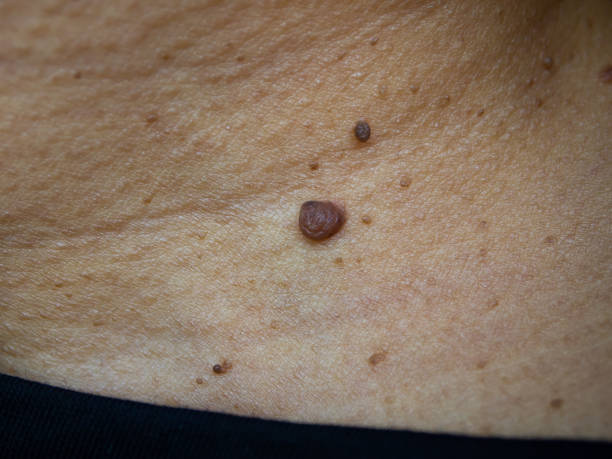 여성의 목에 갈색 두더지, 의학, 클로즈업 및 매크로 샷, 선택적 초점, 아시아 바디 피부 부분, 헬스케어 개념 - breast chest the human body human skin 뉴스 사진 이미지