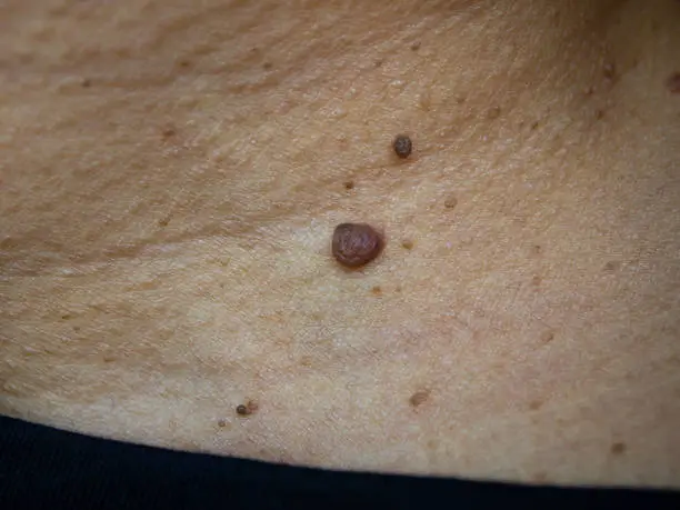 Brown moles on woman's neck, Medicine, Close up & Macro shot, Selective focus, Asian Body skin part, Healthcare concept