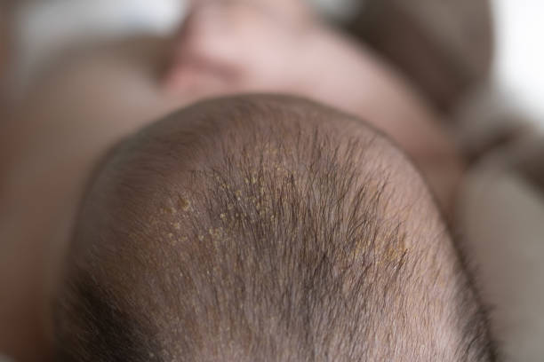 Small yellow dry peel crusts on the baby’s head. Seborrheic dermatitis, dandruff in the hair of a newborn. stock photo