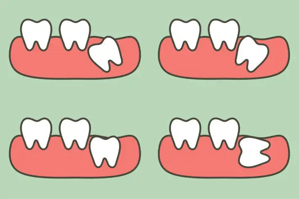 Vector illustration of type of wisdom tooth affect to other teeth
