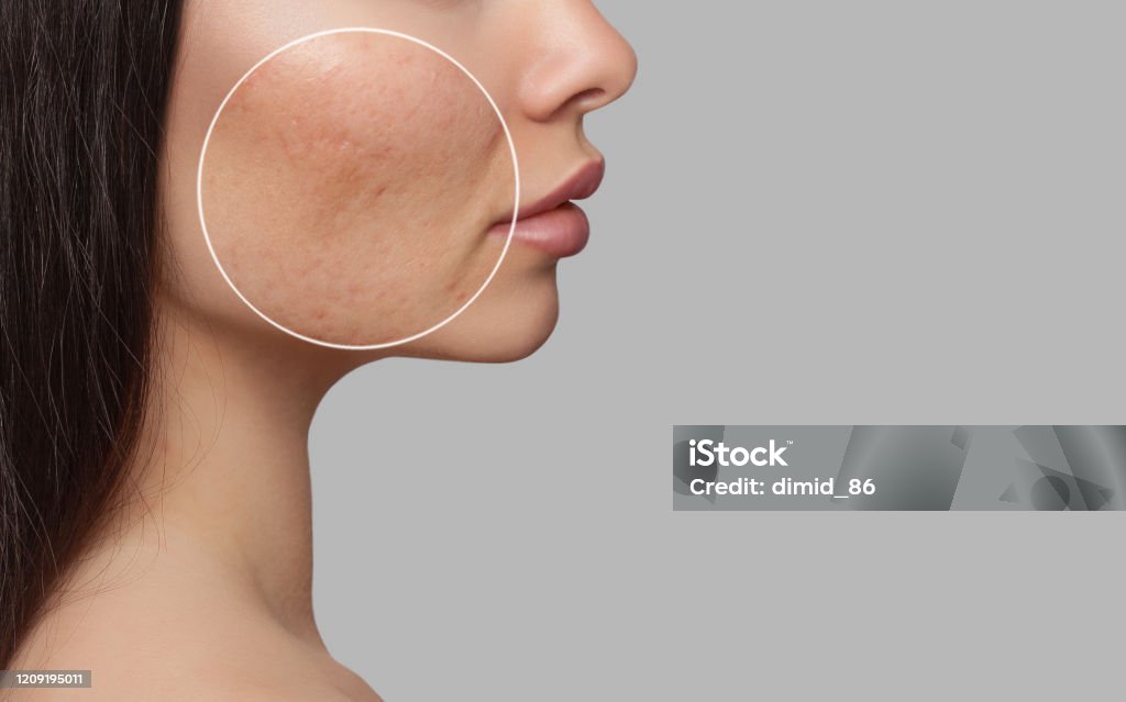 Foto vor und nach der Behandlung von Akne. Ein junges Mädchen mit einer Problemhaut. Hautbehandlungen. Kosmetologie und professionelle Hautpflege. - Lizenzfrei Akne Stock-Foto Foto vor und nach der Behandlung von Akne. Ein junges Mädchen mit einer Problemhaut. Hautbehandlungen. Kosmetologie und professionelle Hautpflege. - Lizenzfrei Akne Stock-Foto