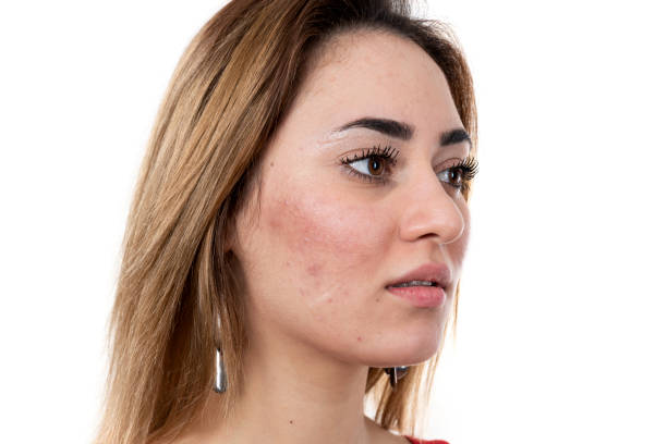 istock Unfiltered young female skin. No filter. 1209211683