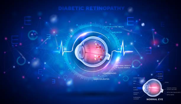 Eye with Diabetic retinopathy Eye with Diabetic retinopathy, vision disorder and normal eye anatomy on an abstract blue scientific background, detailed info poster digital futuristic illustration diabetes backgrounds stock illustrations