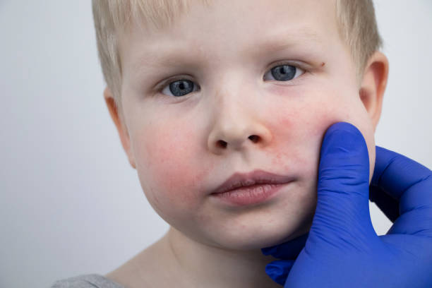 alergia en forma de enrojecimiento de la cara y erupciones cutáneas, prische en un niño. un niño examinado por un pediatra en un hospital. el pediatra examina las mejillas rojas - piel enrojecida fotografías e imágenes de stock