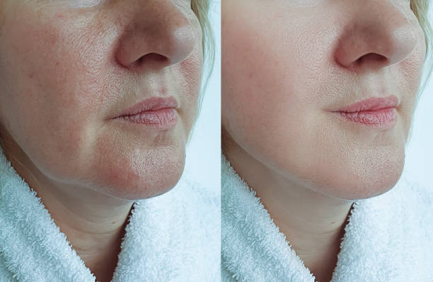 istock face old woman wrinkles before and after treatment 1209313699