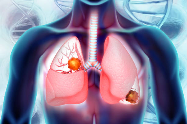 폐암. 폐 질환 - human lung asthmatic x ray human internal organ 뉴스 사진 이미지