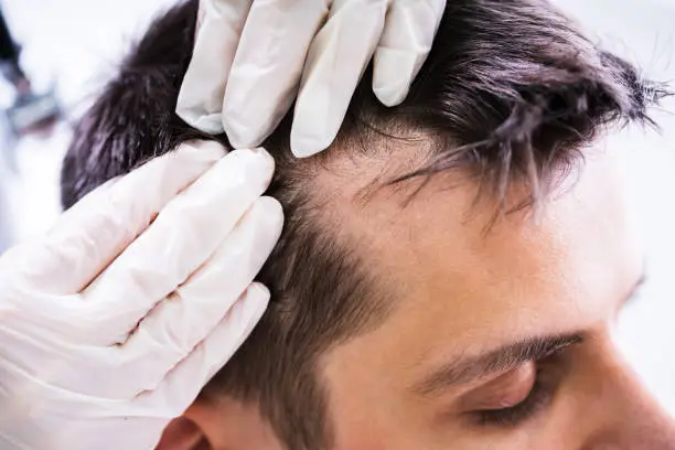 Close-up Of A Dermatologist's Hand Checking Patient's Hair