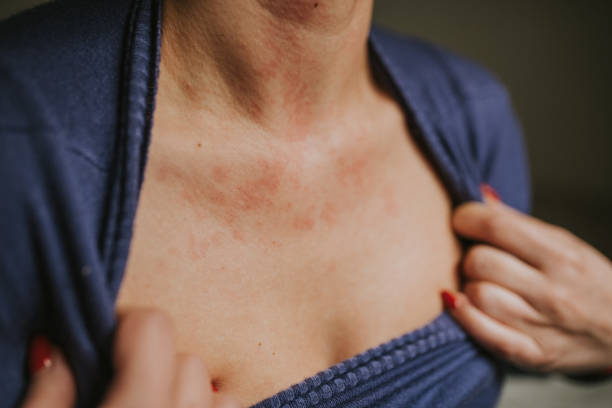 Woman show off manifestation of skin allergy stock photo