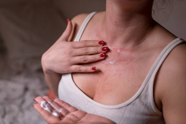 Woman with skin allergy applying cream on chest stock photo