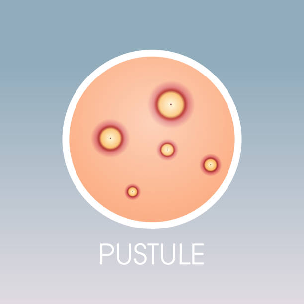 What is Comedones on Face: Unmasking Those Pesky Pores!