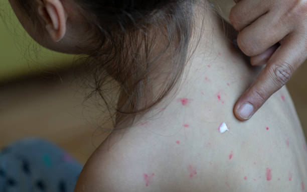 Measles Father taking care of girl with chicken pox. measles stock pictures, royalty-free photos & images