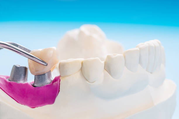 istock Implant Prosthodontics or Prosthetic 1209820926