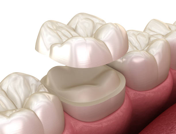 istock Onlay ceramic crown fixation over molar tooth. Medically accurate 3D illustration of human teeth treatment 1209852951