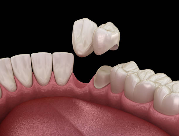 istock Cantilever bridge made from ceramic, frontal tooth recovery. Medically accurate 3D animation of dental concept 1209852998