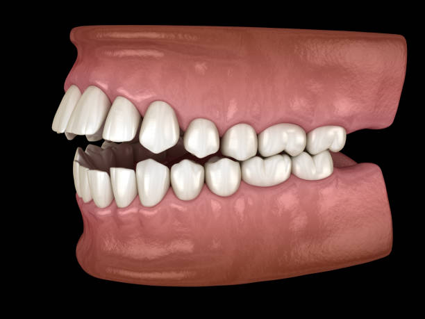 istock Openbite dental occlusion ( Malocclusion of teeth ). Medically accurate tooth 3D illustration 1209854049