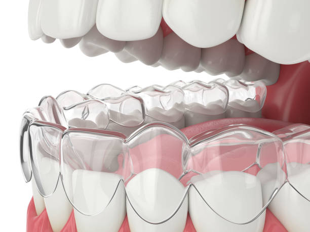 istock 3d render of jaw with invisalign removable retainer 1210031964