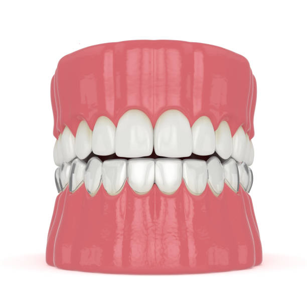 istock 3d render of jaw with invisalign removable retainer 1210031979